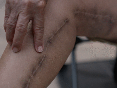 A close-up shows a person’s hand gently touching a long, healed scar running along their leg. The image represents the lasting physical and emotional impact of scarring after a motor vehicle accident in Santa Barbara, emphasizing issues like pain, disfigurement, and the importance of documenting injuries for compensation under California law.