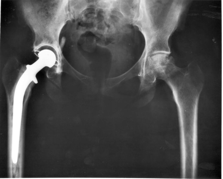 x-ray of a failed hip replacent device