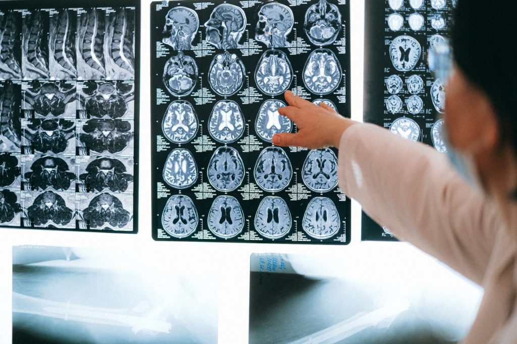 doctor pointing to injury on brain scan
